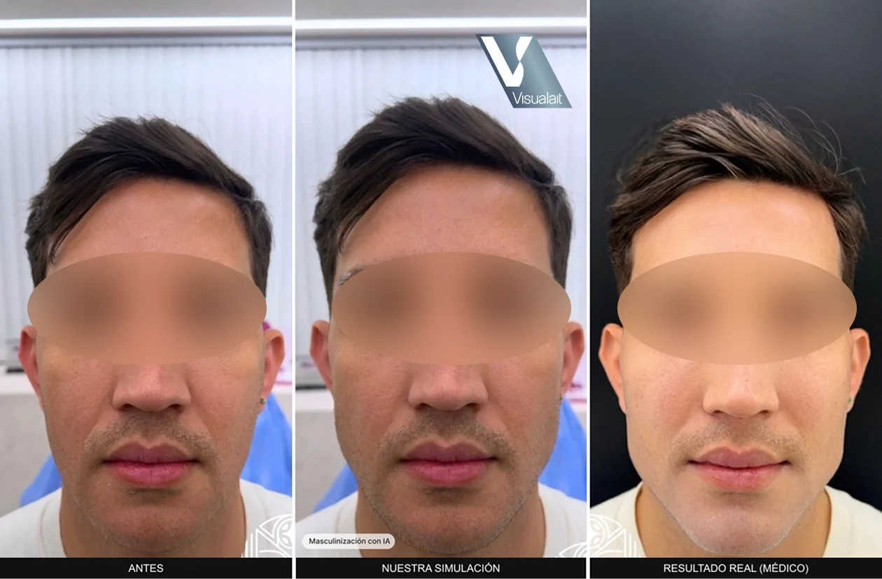 Tres fotos de frente del mismo hombre: su cara original, la simulación de Visualait y el resultado real del médico.