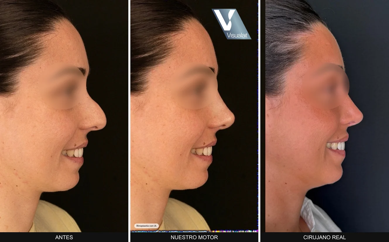 Tres fotos de perfil de la misma mujer: su nariz original, la simulación de Visualait y el resultado de la cirugía real.