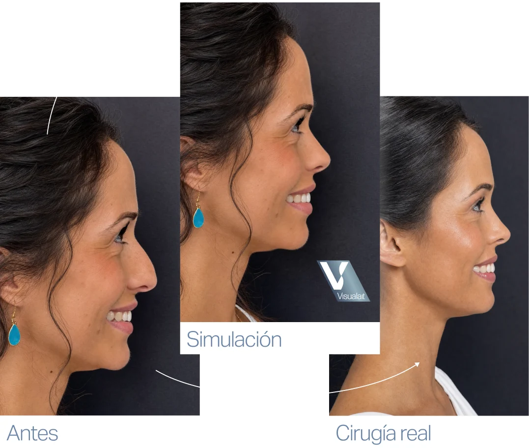 La misma mujer de perfil en tres imágenes: su foto original, la simulación de la rinoplastia y el resultado de la cirugía real.